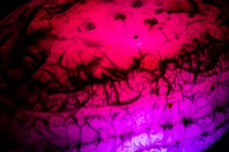 Photo manage temporal lobe auras