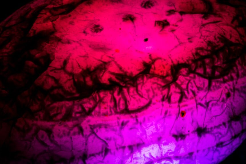 Photo manage temporal lobe auras