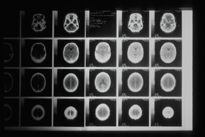 Photo Rosenhan study psychiatric diagnosis validity